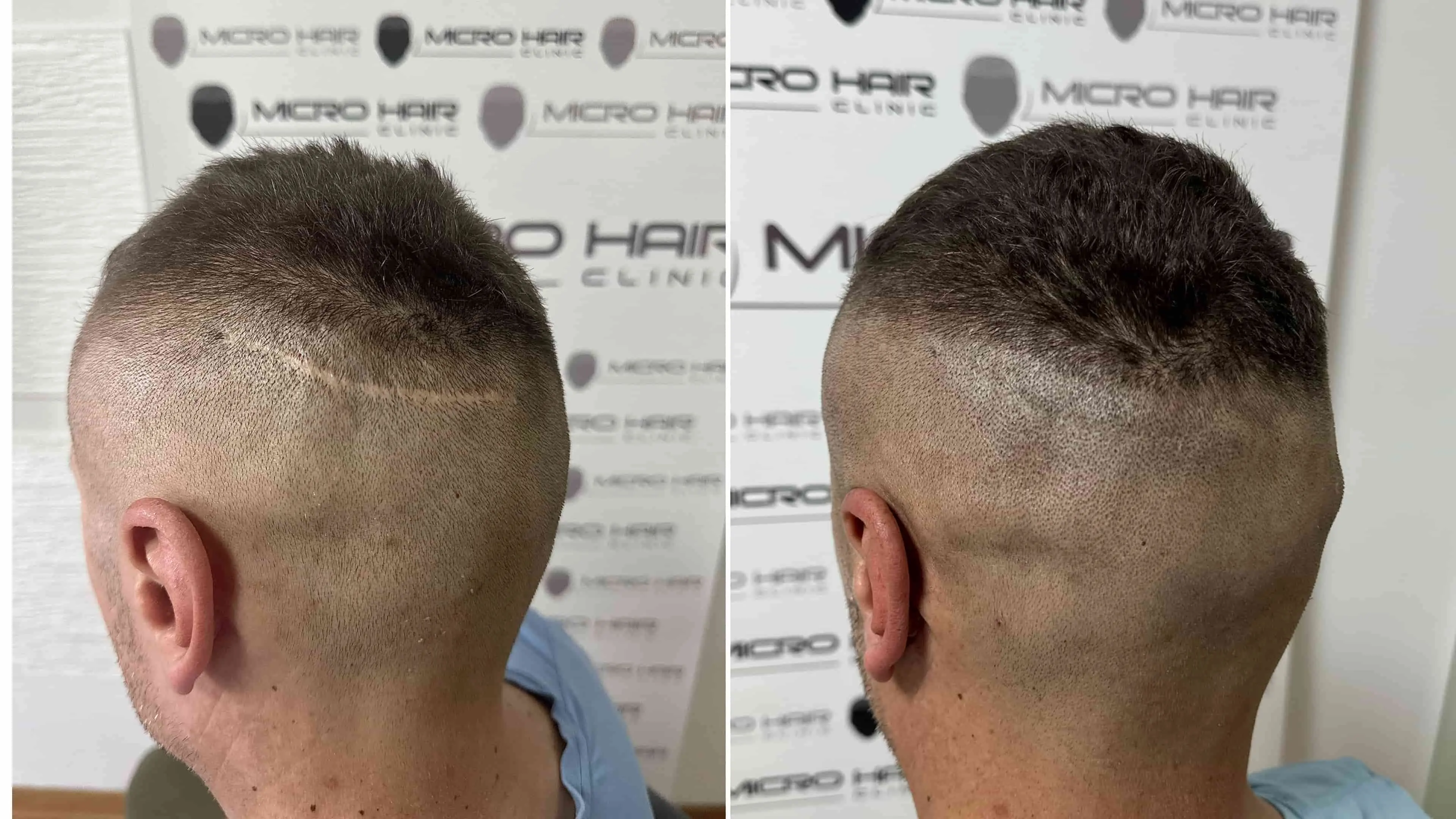 SMP za brazgotine – po presaditvi, poškodbah ali operacijah